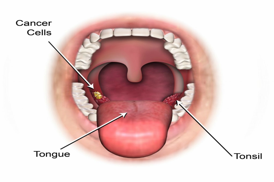 Salivary Glands Cancer Image